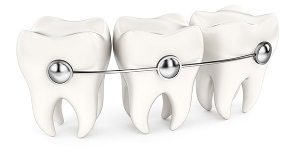 Metal Braces in Torrance CA