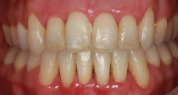 After Orthodontist Treatment Image 3