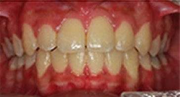 After Orthodontist Treatment Image 4