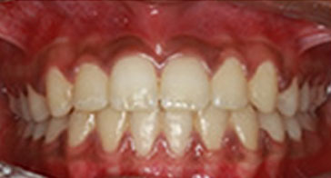 After Orthodontist Treatment Image 5