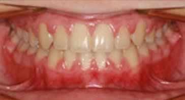 Before Orthodontist Treatment Image 1
