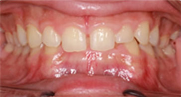 Before Orthodontist Treatment Image 2