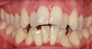 Before Orthodontist Treatment Image 3