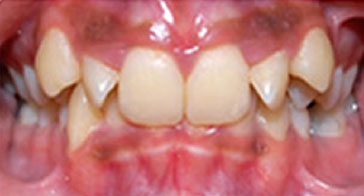 Before Orthodontist Treatment Image 4