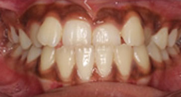 Before Orthodontist Treatment Image 5