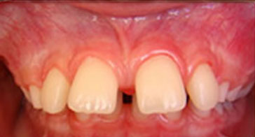 Before Orthodontist Treatment Image 6